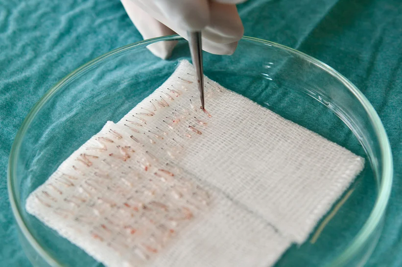 a gloved hand holding a needle over pieces of hair follicle